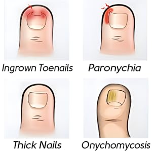 Ingrown Toenail Clippers(Upgrade), Steel Nail Clippers for Professional Podiatrist, Unique Long Handle Curved Blade Tool for Thick & Ingrown Nails, Suitable for Men, Women and Elderly-XIORRY