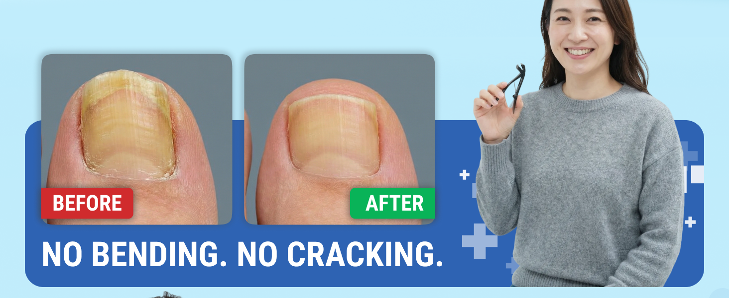 Toenail Clippers for Thick Toenails – KLIPP 15 mm Wide Jaw Thick Fingernail and Toenail Cutter with Curved Stainless-Steel Blades for Seniors (Angled Wide Opening)